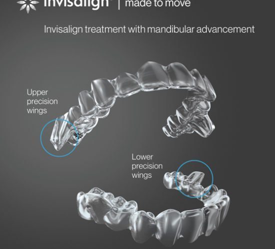 INVISALIGN TEEN CON AVANCE MANDIBULAR - Cursos Ortodoncia Invisible Cristina Viyuela