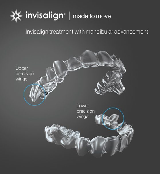 INVISALIGN TEEN CON AVANCE MANDIBULAR - Cursos Ortodoncia Invisible Cristina Viyuela