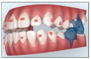 Invisalign Teen con avance mandibular 4 cristina viyuela madrid