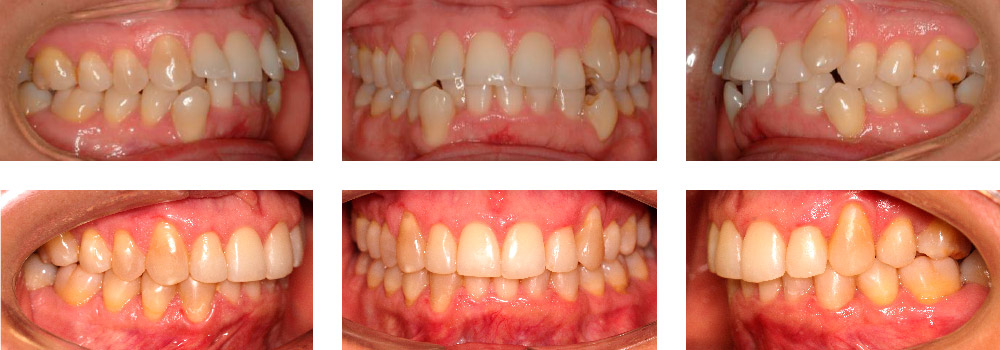 apinamiento-severo-mia-frontal