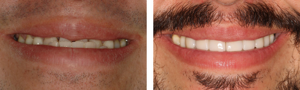 CLASE III DENTARIA + CARILLAS CVIYUELA - Cursos Ortodoncia Invisible Cristina Viyuela