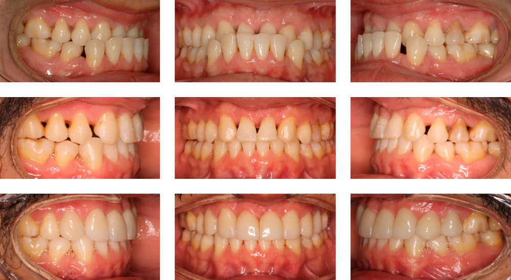 CLASE III DENTARIA + CARILLAS CVIYUELA - Cursos Ortodoncia Invisible Cristina Viyuela