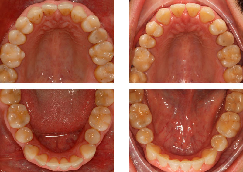 CLASE III DENTARIA + CARILLAS CVIYUELA - Cursos Ortodoncia Invisible Cristina Viyuela