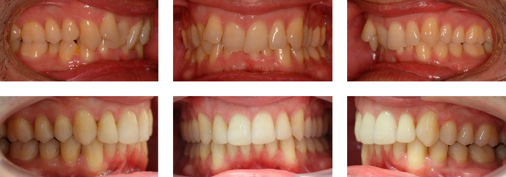 invisalign-cf-frontal