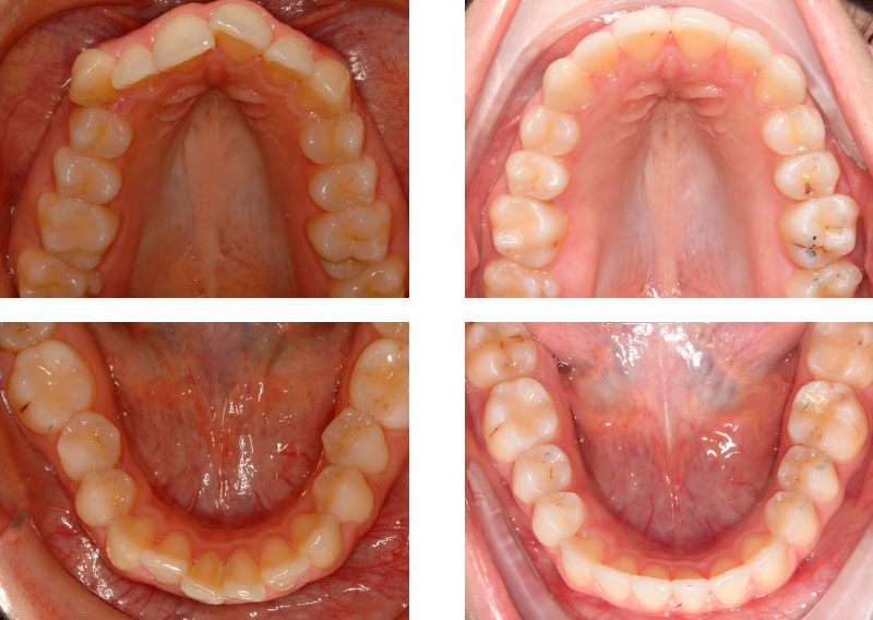 CLASE II MOLAR Y CANINA - Cursos Ortodoncia Invisible Cristina Viyuela