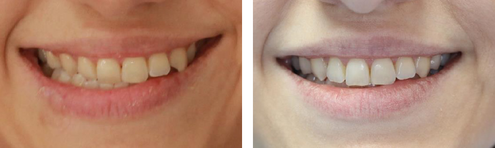 MORDIDA CRUZADA DE TRES DIENTES - Cursos Ortodoncia Invisible Cristina Viyuela
