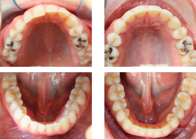 MORDIDA CRUZADA DE TRES DIENTES - Cursos Ortodoncia Invisible Cristina Viyuela