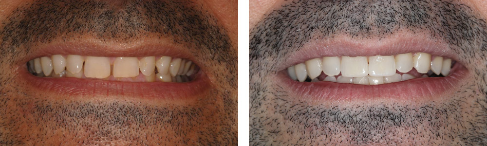 MORDIDA PROFUNDA + ESTÉTICA FINAL - Cursos Ortodoncia Invisible Cristina Viyuela