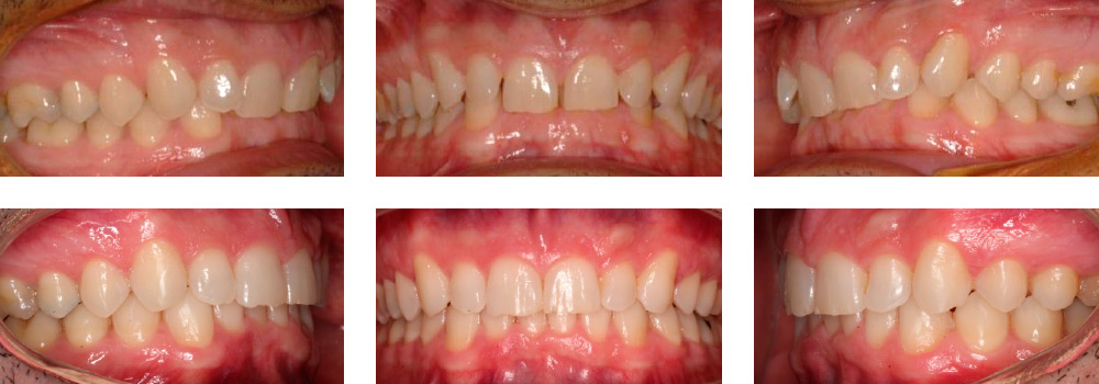 mordida-y-estetica-vs-frontal