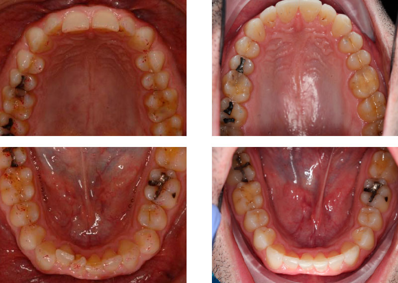 MORDIDA PROFUNDA + ESTÉTICA FINAL - Cursos Ortodoncia Invisible Cristina Viyuela